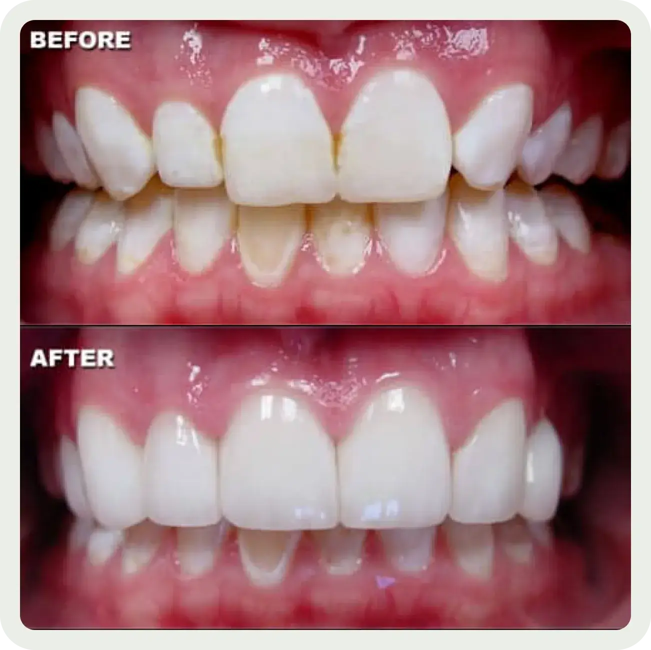 A before and after picture of a smile makeover.