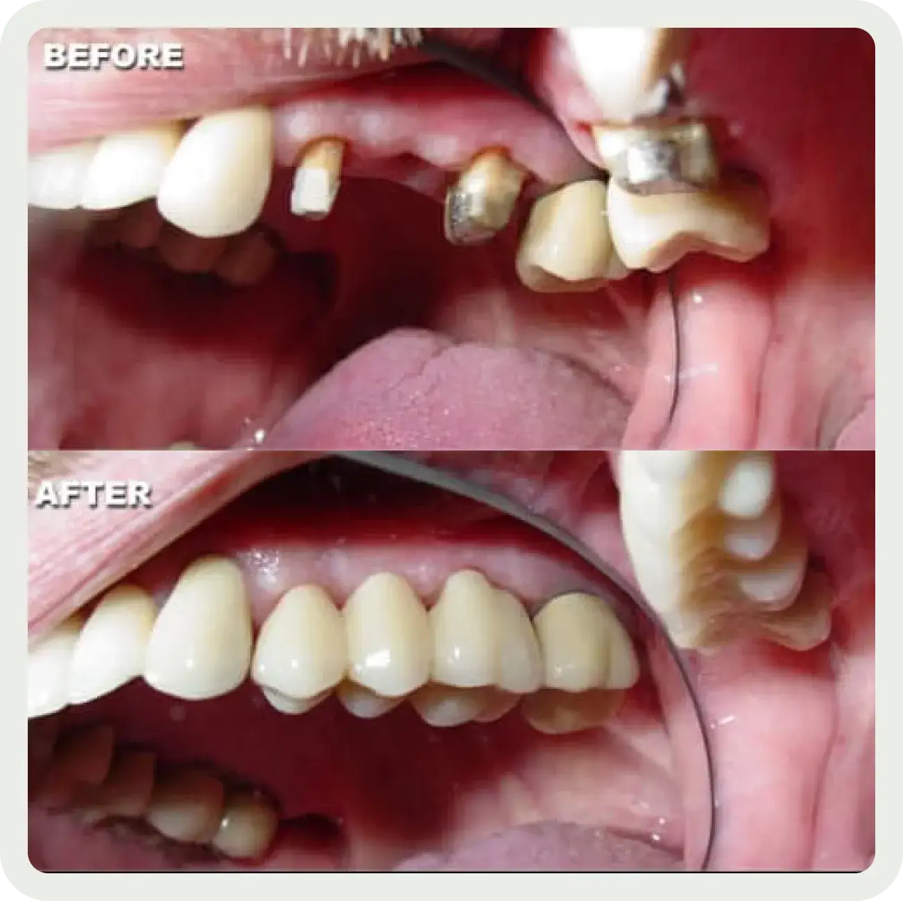 A before and after picture of a patient's teeth.