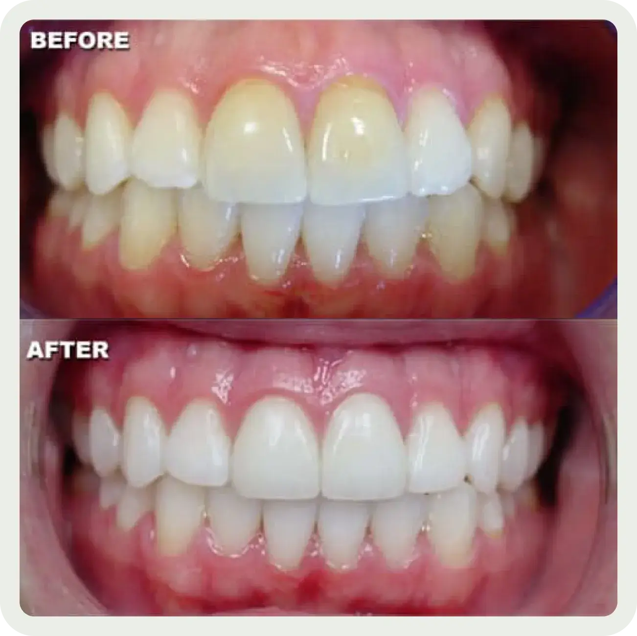 The before and after of a smile makeover.