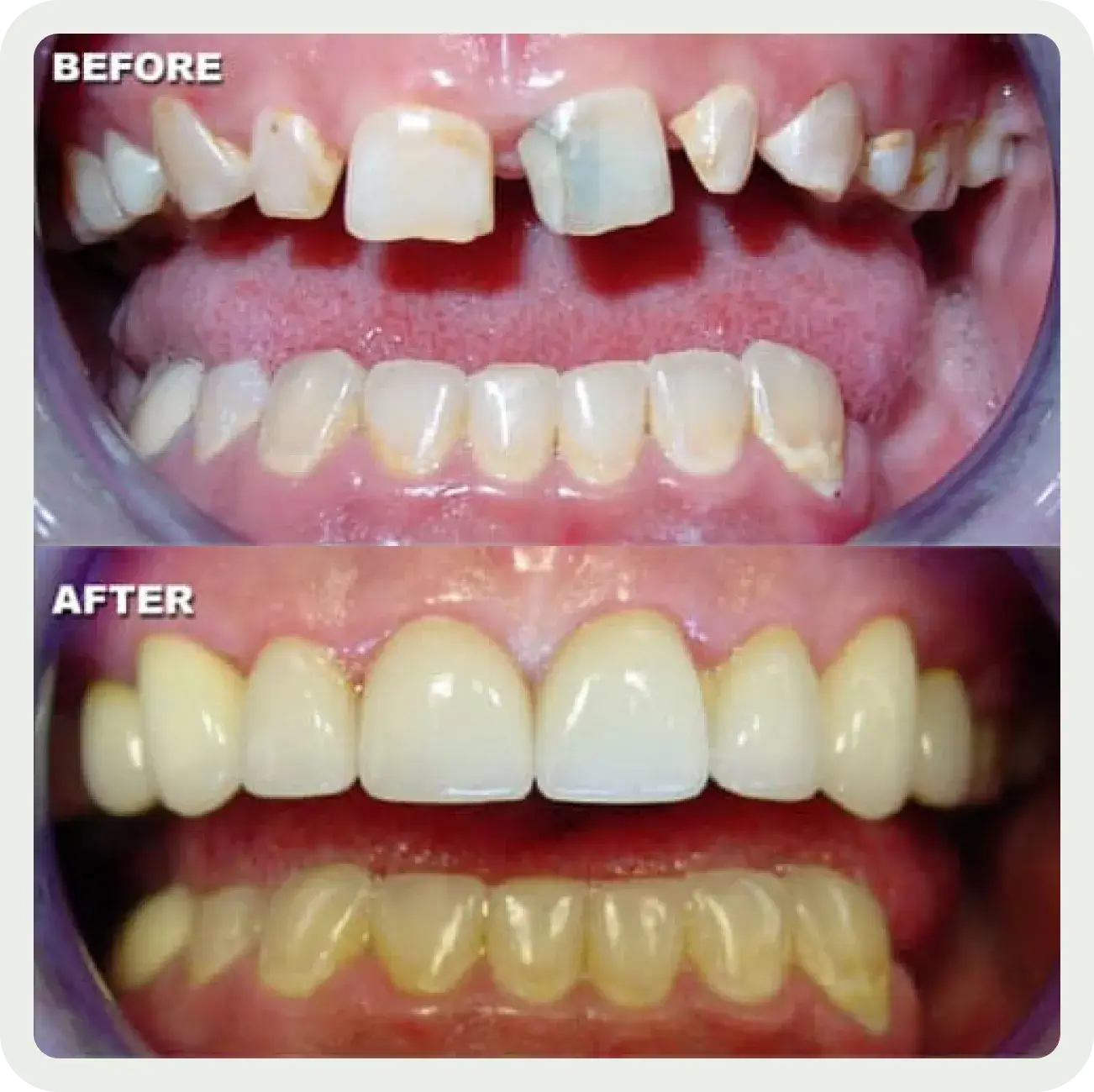 A before and after picture of a smile makeover.