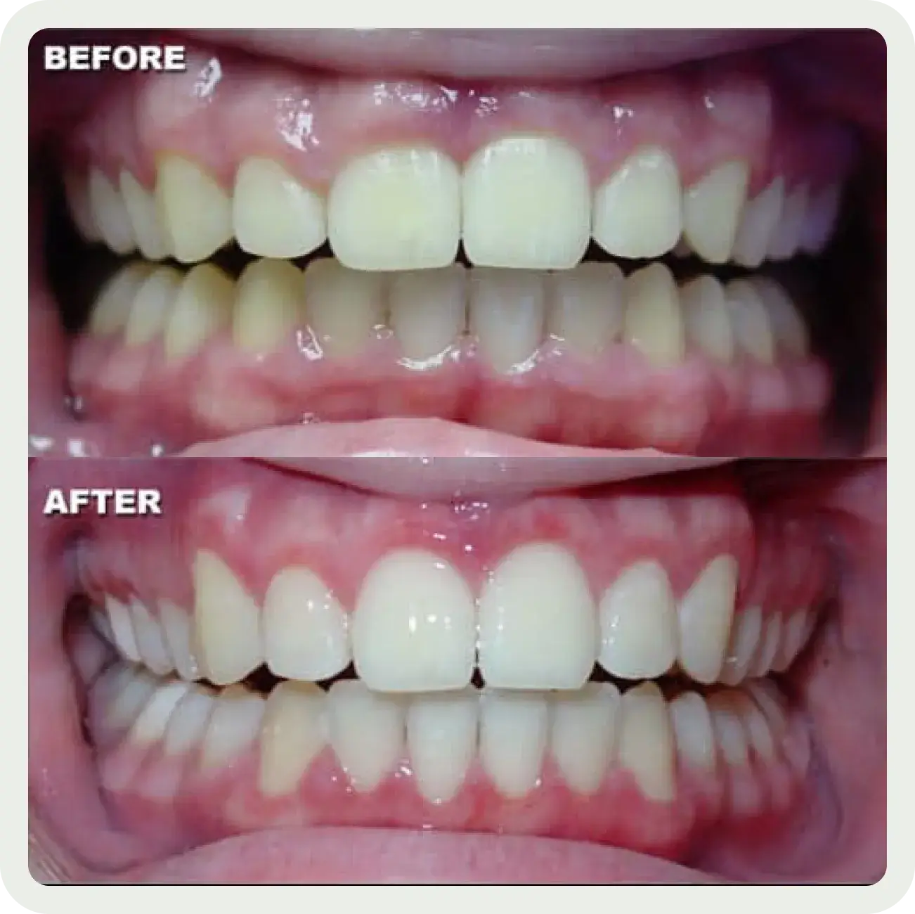 A before and after picture of a smile.