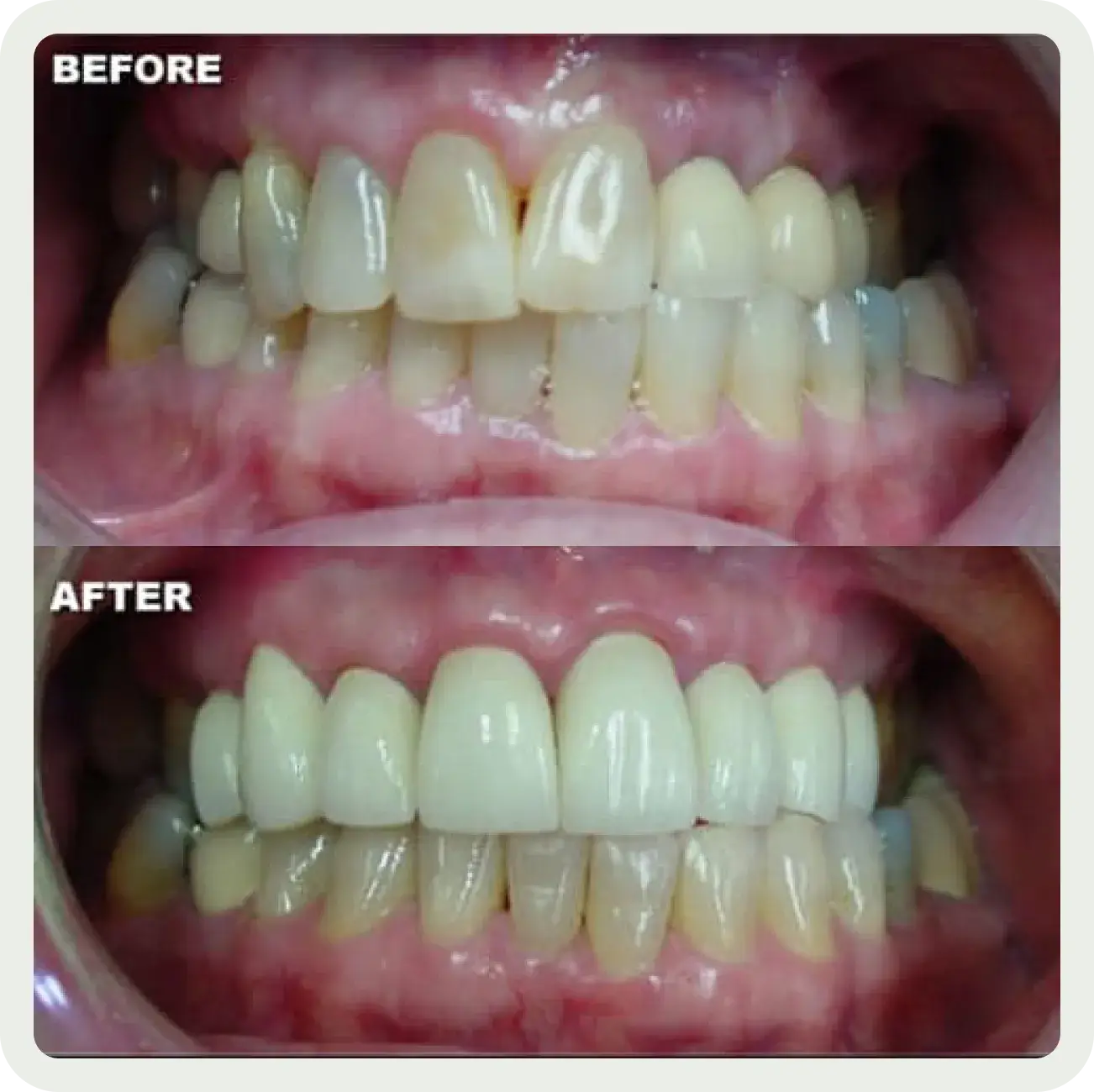 A before and after picture of a smile makeover.