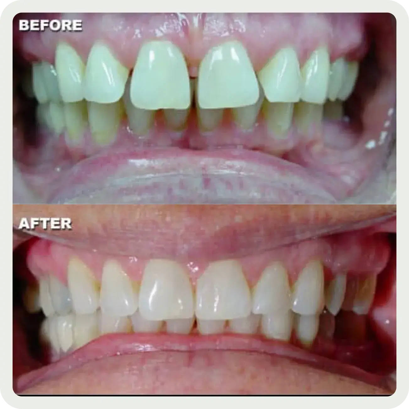 A before and after picture of a smile makeover.