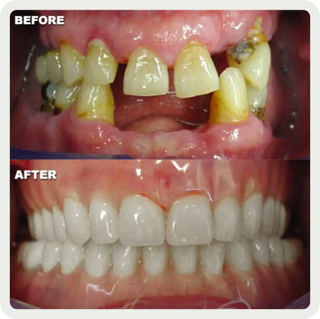 A before and after picture of a smile makeover.