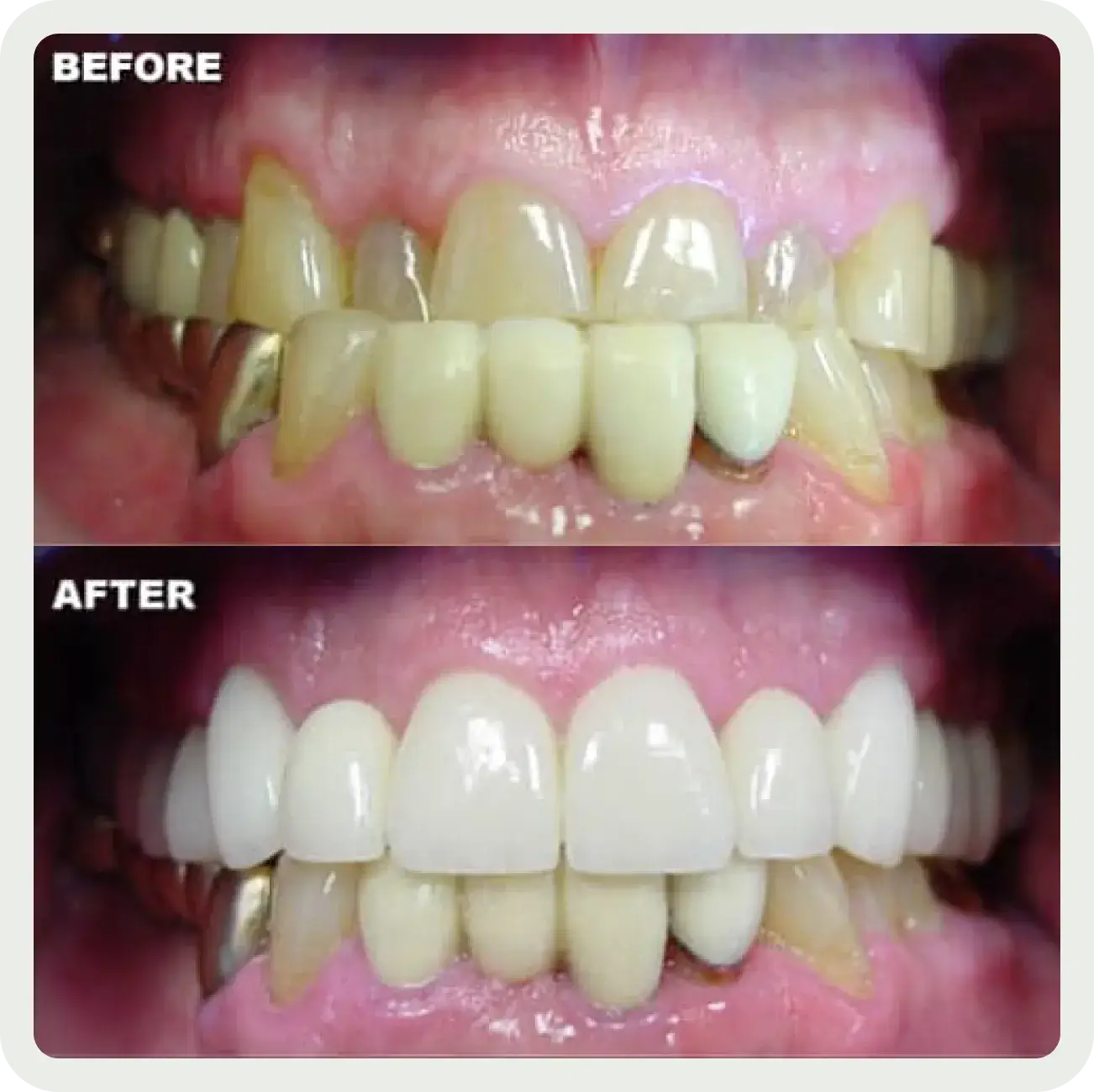 A before and after picture of a smile makeover.