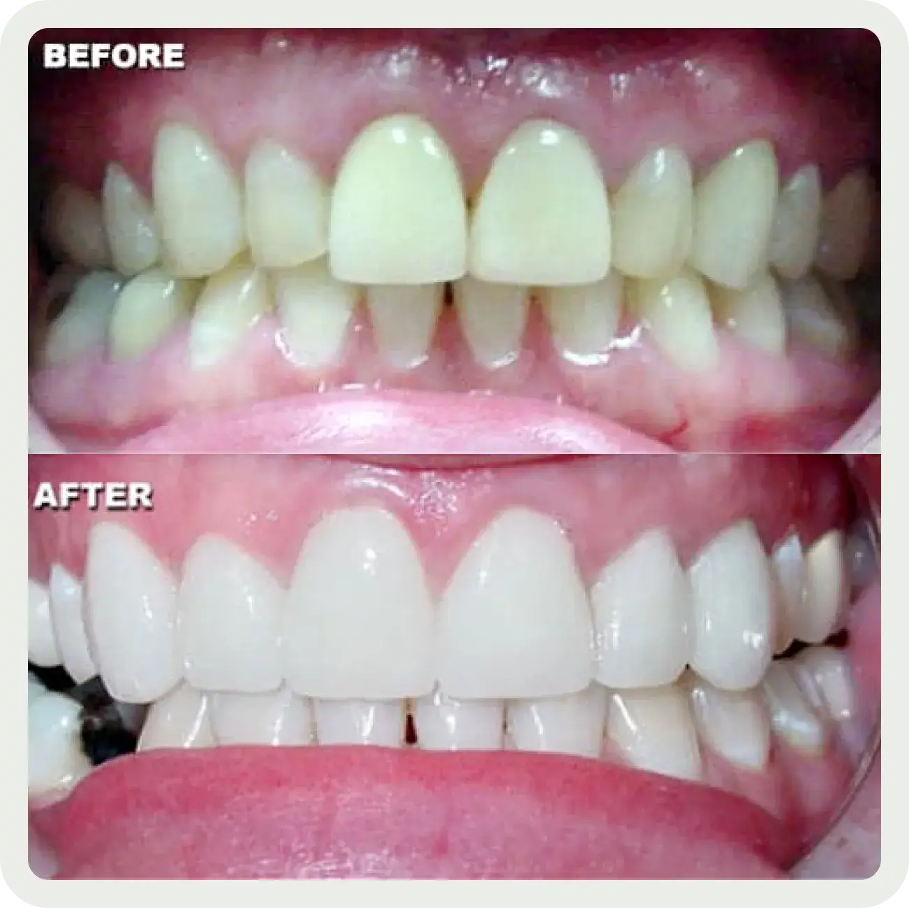 A before and after picture of a teeth whitening treatment.