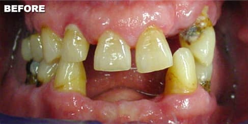 Before Dental Procedure
